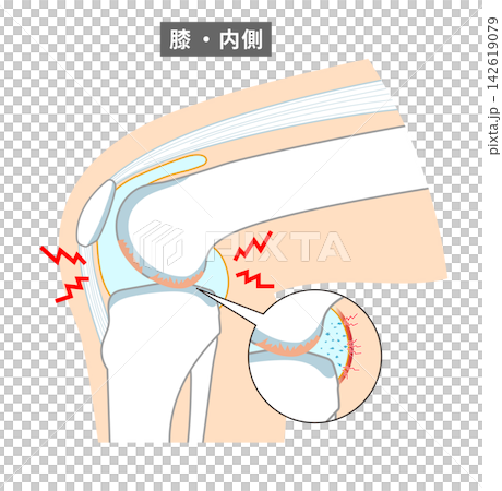 An anatomical diagram showing how the knee joint and knee cartilage wear down. An anatomical diagram showing how the knee joint and knee cartilage wear down. 142619079