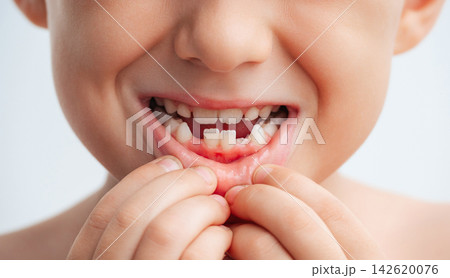 Close-up of child's mouth with missing primary teeth during natural dental development. Concept of tooth loss, permanent teeth growth and children's oral health 142620076