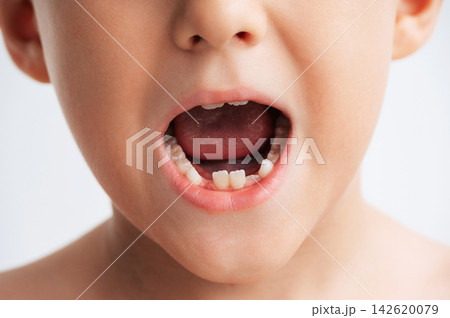 Close-up portrait of a young child with missing baby tooth during natural tooth loss and dental development. Concept of children's oral health, primary teeth, permanent teeth, pediatric dentistry 142620079