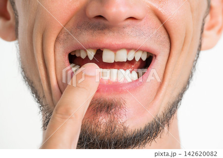 male missing upper front tooth removed. Dental surgery and dental implantation. Dental problems. Portrait of a adult man without a tooth on white isolated background male missing upper front tooth removed. Dental surgery and dental implantation. Dental problems. Portrait of a adult man without a tooth on white isolated background 142620082