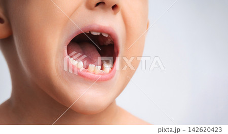 child's lost baby teeth in close-up. Pediatric dentistry and dental care for children. The concept of pediatric dentistry, replacement of baby teeth for permanent teeth on a white isolated background child's lost baby teeth in close-up. Pediatric dentistry and dental care for children. The concept of pediatric dentistry, replacement of baby teeth for permanent teeth on a white isolated background 142620423