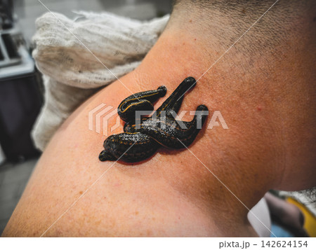 Medicinal leeches performing hirudotherapy treatment on a man's neck, using a bloodletting technique as an alternative medicine approach for wellness and detoxification. Medicinal leeches performing hirudotherapy treatment on a man's neck, using a bloodletting technique as an alternative medicine approach for wellness and detoxification. 142624154