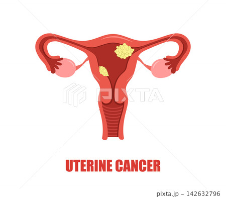 Uterine cancer. Carcinoma of Cervix. Vaginal bleeding. Medical Vector illustration 142632796