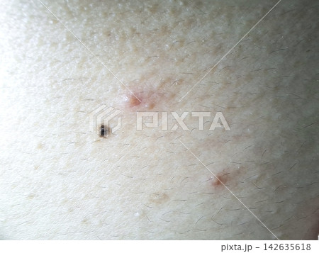 Close up view of skin irregularities including a pigmented nevus and inflammatory lesions. Educational medical macro photography. 142635618