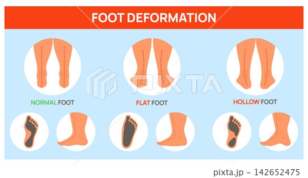 Poster on foot deformities. Medical diagram showing types of legs deformations. Flat feet, pronation and normal sole. Anatomical pathology. Orthopedic disrober infographic vector banner 142652475