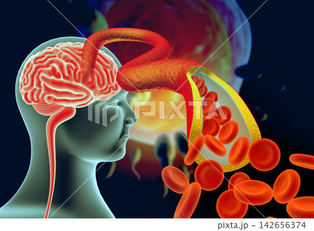 Cholesterol plaque in artery with human brain anatomy Cholesterol plaque in artery with human brain anatomy 142656374