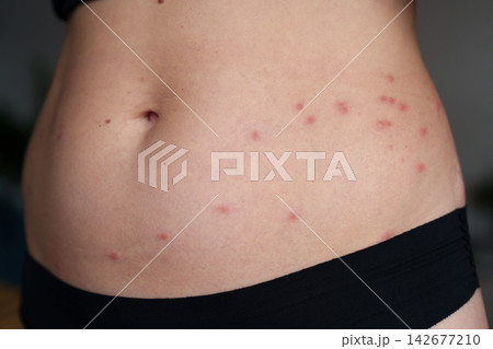 Harvest mite bites causing red itchy rash on woman abdomen 142677210
