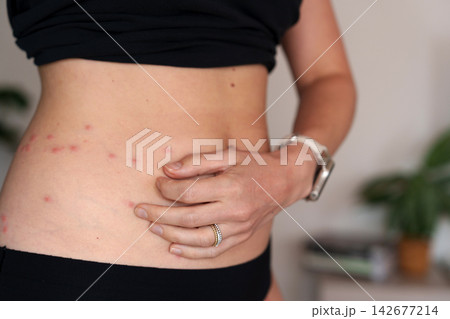 Woman scratching red itchy rash on abdomen in soft home light Woman scratching red itchy rash on abdomen in soft home light 142677214
