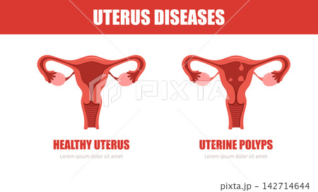 Uterus diseases. Uterine polyps concept. Medical check up. Vector illustration in flat style Uterus diseases. Uterine polyps concept. Medical check up. Vector illustration in flat style 142714644
