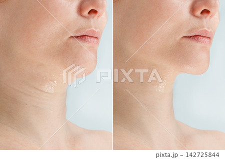 Before and After Chin Rejuvenation Treatment Showing Reduced Double Chin and Firmer Skin Before and After Chin Rejuvenation Treatment Showing Reduced Double Chin and Firmer Skin 142725844