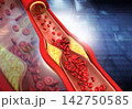 Clogged arteries, Cholesterol plaque in artery 142750585