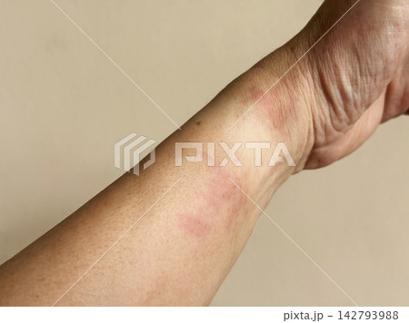 Red Allergic Skin Rash and Dermatitis on Human Wrist Red Allergic Skin Rash and Dermatitis on Human Wrist 142793988