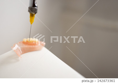 Dental prosthesis injection with carpule syringe in clinical workflow 142873361