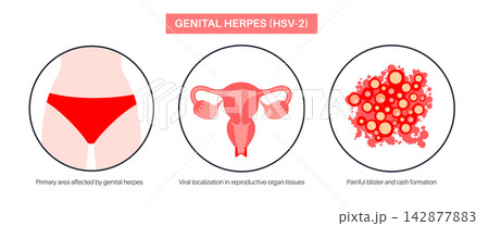 Genital herpes main symptoms 142877883