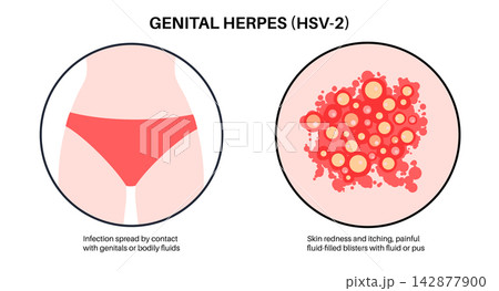 Groin skin rash symptoms Groin skin rash symptoms 142877900