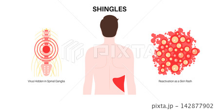 Spinal ganglia development scheme Spinal ganglia development scheme 142877902