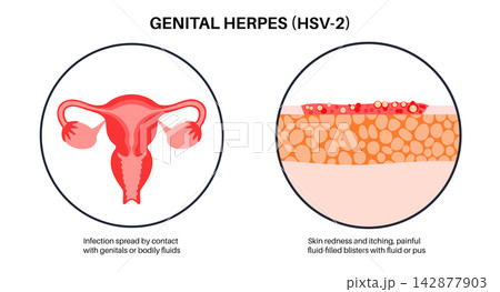 Uterus anatomy blisters diagram 142877903