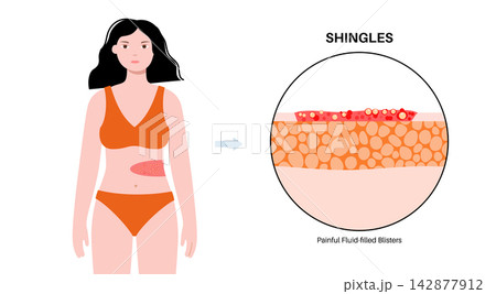 Female abdominal blister zoom 142877912