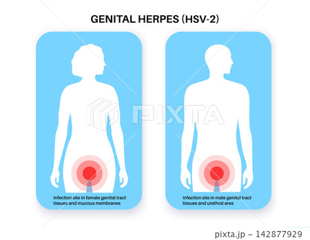 Groin infection site comparison Groin infection site comparison 142877929