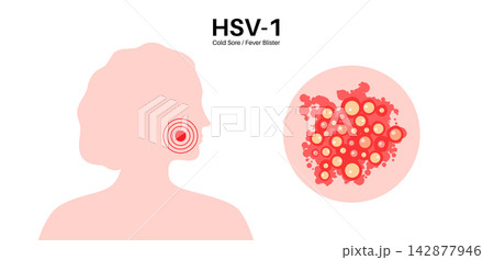 Herpes simplex virus HSV1 Herpes simplex virus HSV1 142877946