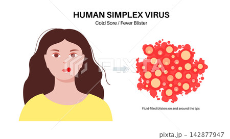 Herpes simplex virus HSV1 Herpes simplex virus HSV1 142877947