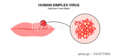 Herpes simplex virus HSV1 142877960