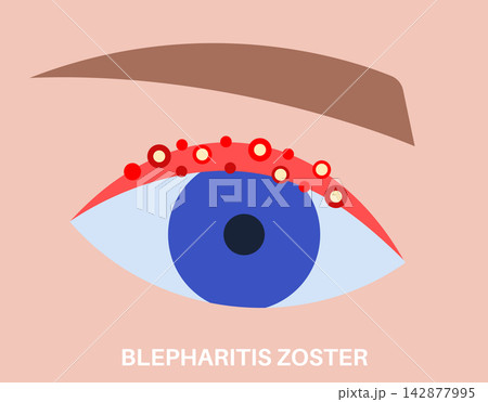Eyelid rash flat icon Eyelid rash flat icon 142877995