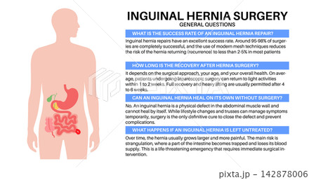 Abdominal Hernia poster Abdominal Hernia poster 142878006