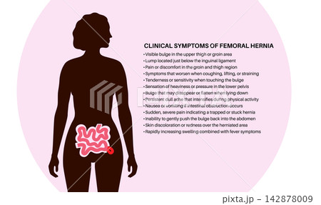Abdominal Hernia poster Abdominal Hernia poster 142878009