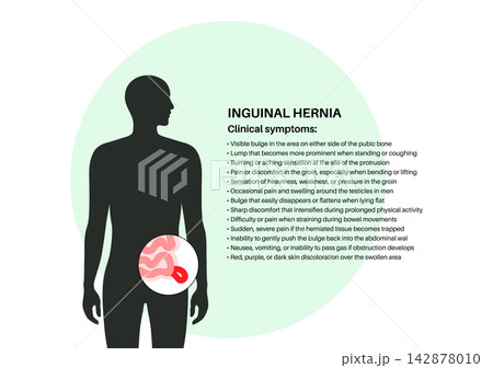 Abdominal Hernia poster Abdominal Hernia poster 142878010