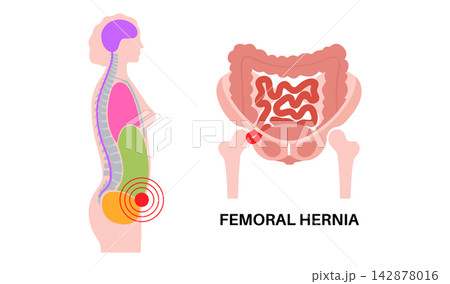 Abdominal Hernia poster Abdominal Hernia poster 142878016