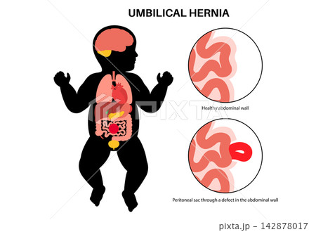 Abdominal Hernia poster Abdominal Hernia poster 142878017