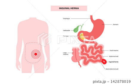 Abdominal Hernia poster Abdominal Hernia poster 142878019