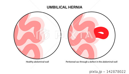 Abdominal Hernia poster Abdominal Hernia poster 142878022