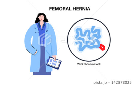 Abdominal Hernia poster Abdominal Hernia poster 142878023