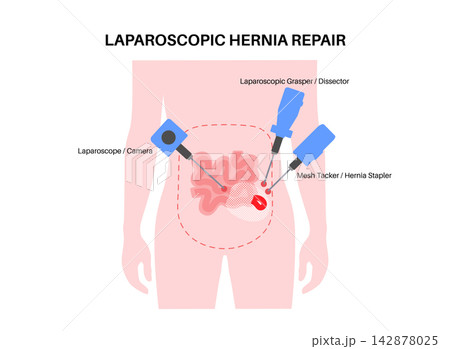 Abdominal Hernia poster Abdominal Hernia poster 142878025