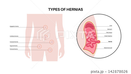 Abdominal Hernia poster Abdominal Hernia poster 142878026