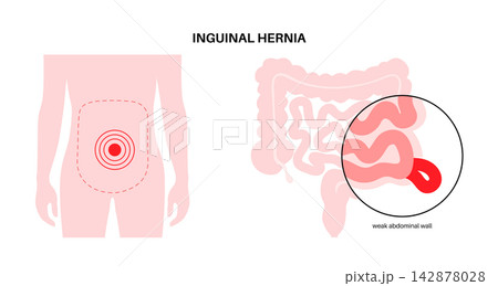 Abdominal Hernia poster 142878028