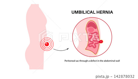 Abdominal Hernia poster Abdominal Hernia poster 142878032