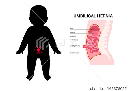 Abdominal Hernia poster Abdominal Hernia poster 142878035