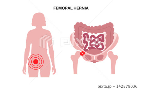 Abdominal Hernia poster Abdominal Hernia poster 142878036
