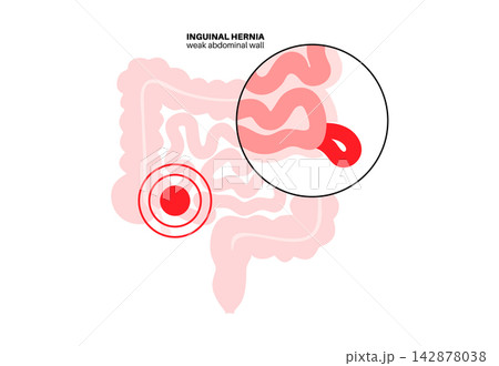 Abdominal Hernia poster Abdominal Hernia poster 142878038