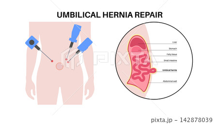 Abdominal Hernia poster Abdominal Hernia poster 142878039