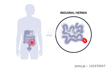 Abdominal Hernia poster Abdominal Hernia poster 142878047