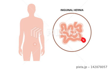 Abdominal Hernia poster Abdominal Hernia poster 142878057