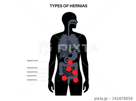 Abdominal Hernia poster Abdominal Hernia poster 142878058