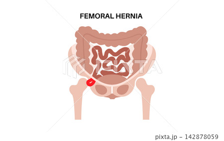 Abdominal Hernia poster Abdominal Hernia poster 142878059