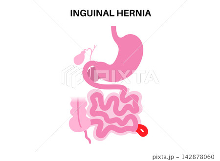 Abdominal Hernia poster Abdominal Hernia poster 142878060