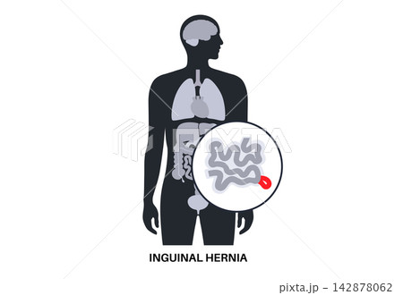 Abdominal Hernia poster 142878062