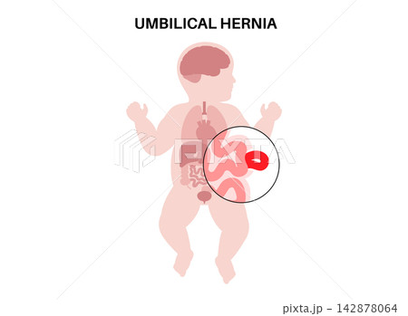 Abdominal Hernia poster Abdominal Hernia poster 142878064